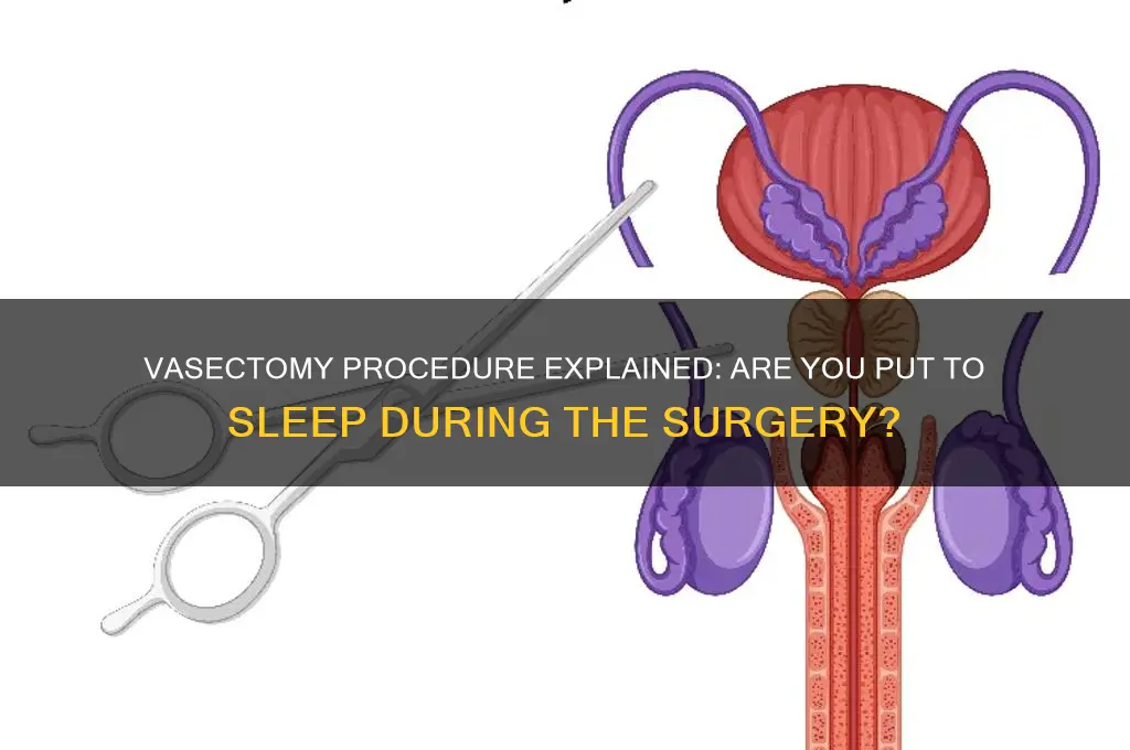 do you get put to sleep for a vasectomy