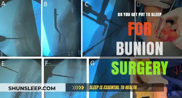 Bunion Surgery Anesthesia: What to Expect During Your Procedure