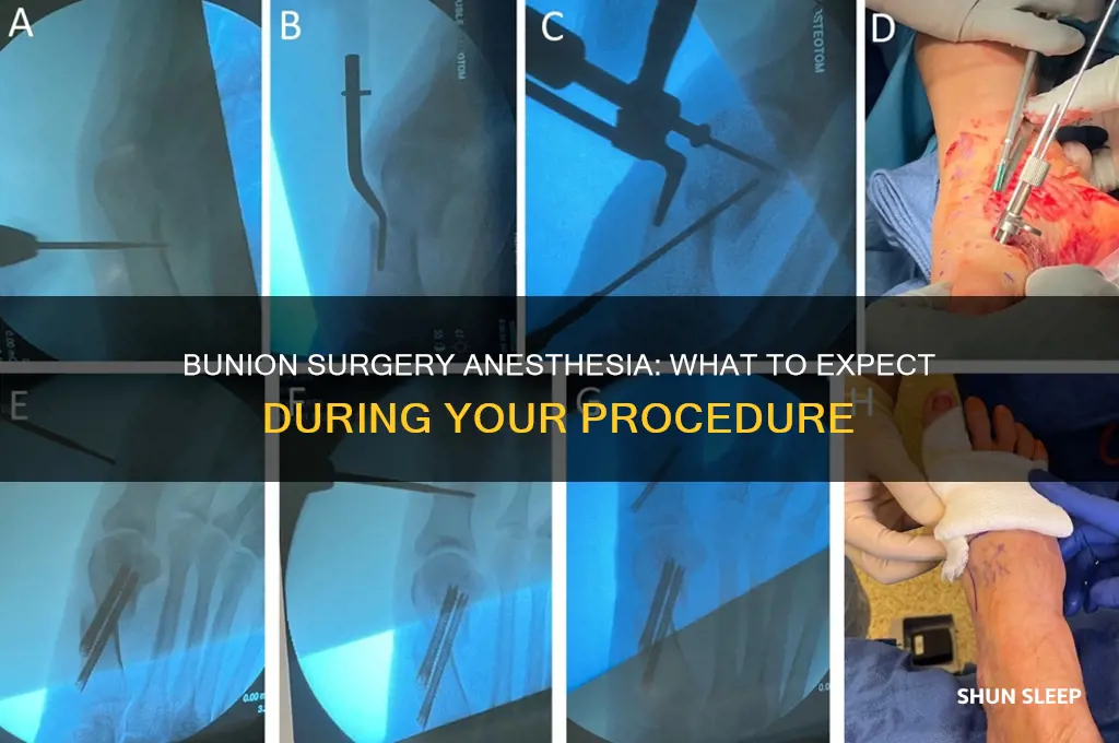 do you get put to sleep for bunion surgery