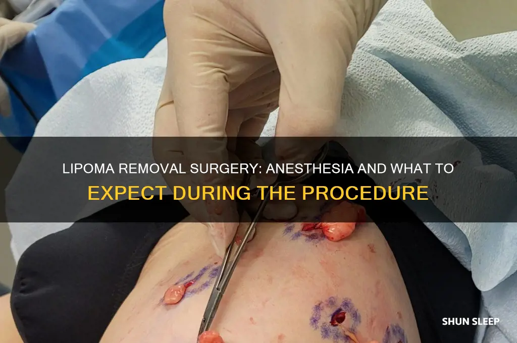 do you get put to sleep for lipoma removal