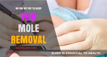 Mole Removal Procedure: Anesthesia Explained and What to Expect