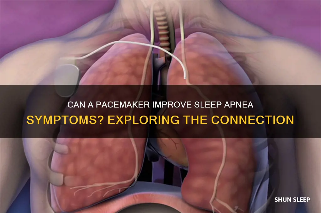 does a pacemaker help sleep apnea