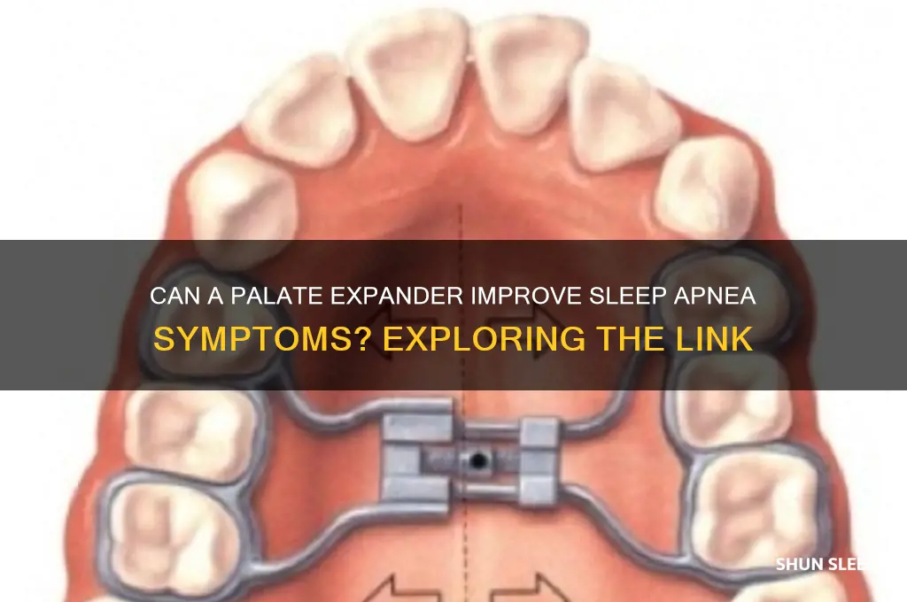does a palette expander help sleep apnea