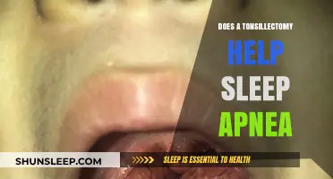 Tonsillectomy for Sleep Apnea: Effective Treatment or Temporary Relief?