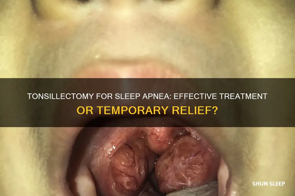 does a tonsillectomy help sleep apnea