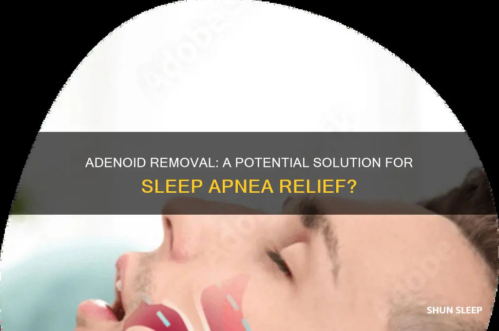 does adenoid removal help sleep apnea