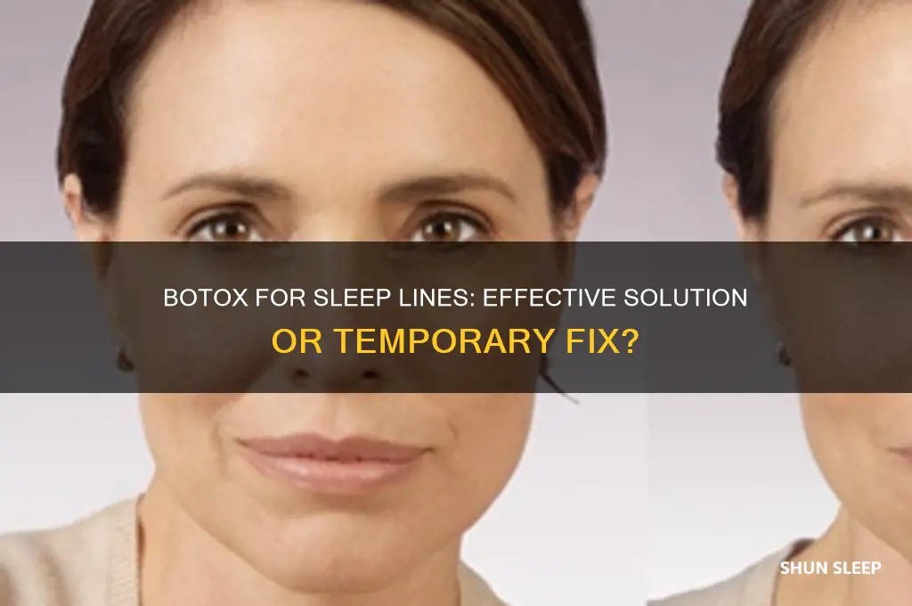 does botox get rid of sleep lines