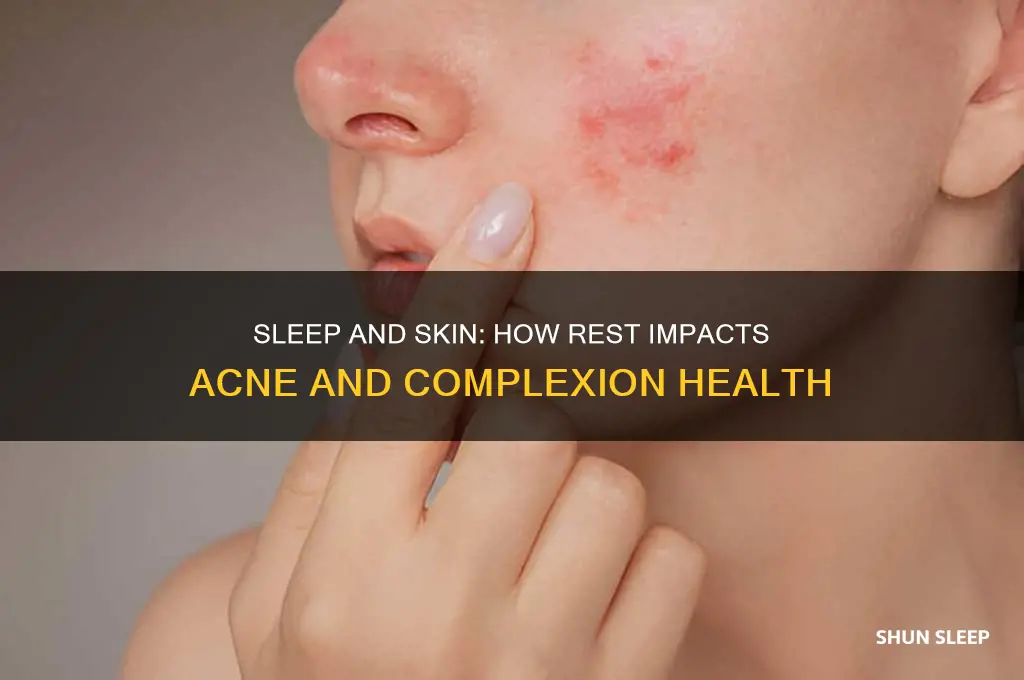 does getting enough sleep help acne