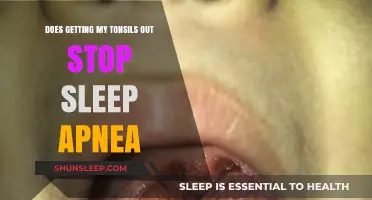 Tonsillectomy and Sleep Apnea: Can Removing Tonsils Improve Breathing?