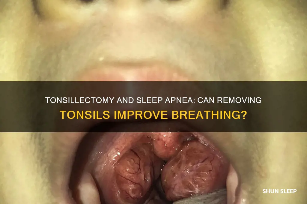 does getting my tonsils out stop sleep apnea
