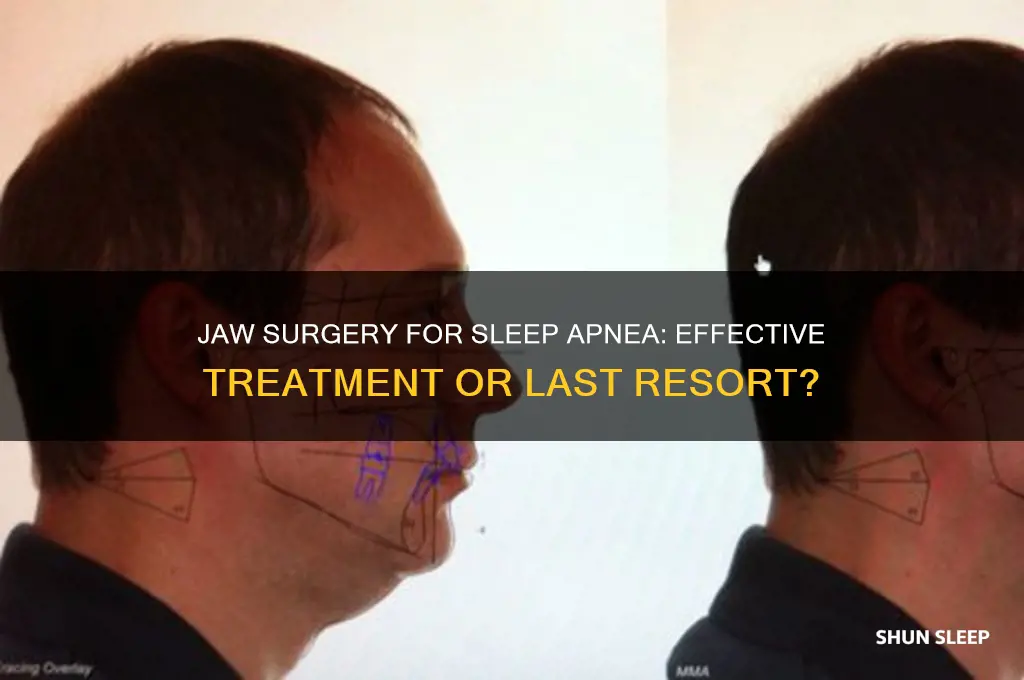 does jaw surgery help sleep apnea