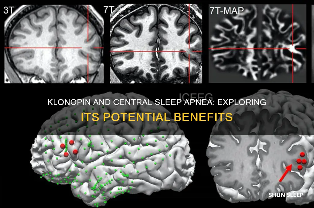 does klonopin help central sleep apnea