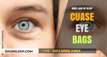 Sleep Deprivation: The Cause of Under-Eye Bags?