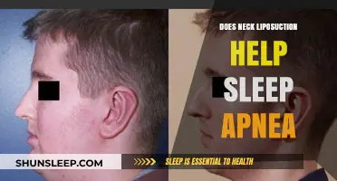 Neck Liposuction and Sleep Apnea: Exploring the Potential Benefits