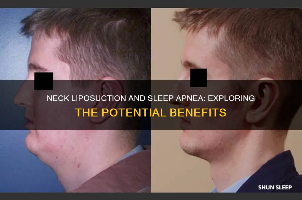 does neck liposuction help sleep apnea