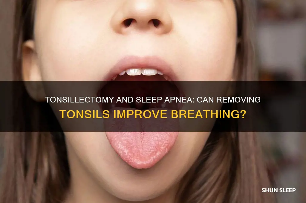 does removal of tonsils help sleep apnea