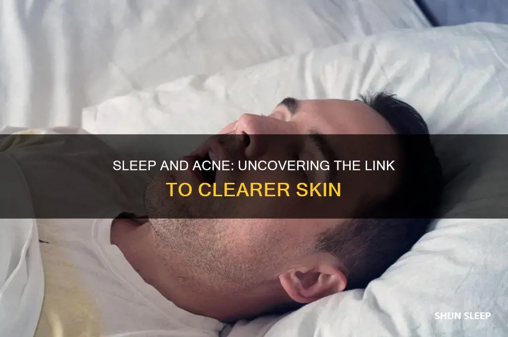 does sleep help acne go away