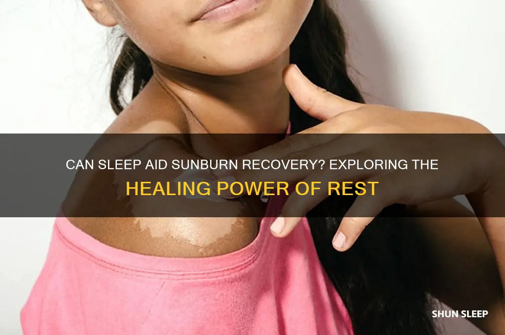 does sleep help get rid of sunburn