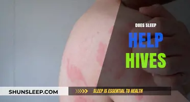 Can Better Sleep Reduce Hives Symptoms? Exploring the Connection