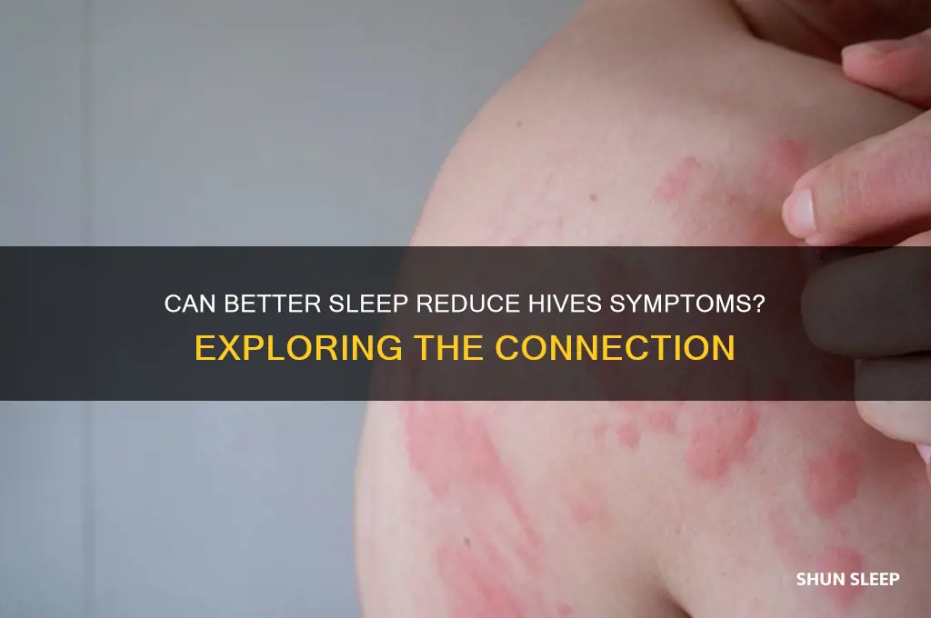 does sleep help hives