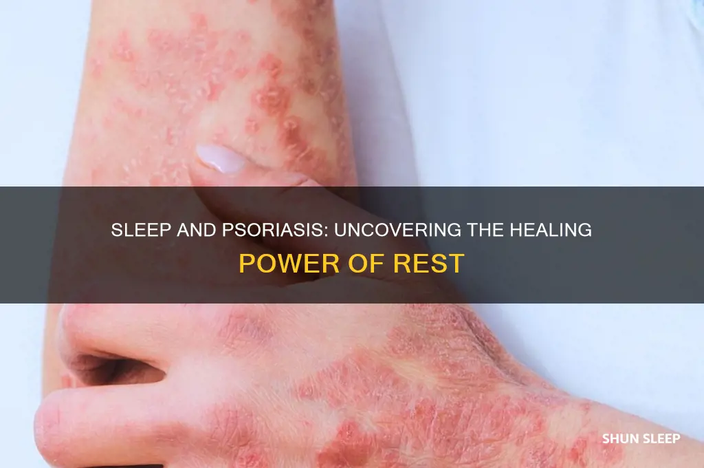 does sleep help psoriasis
