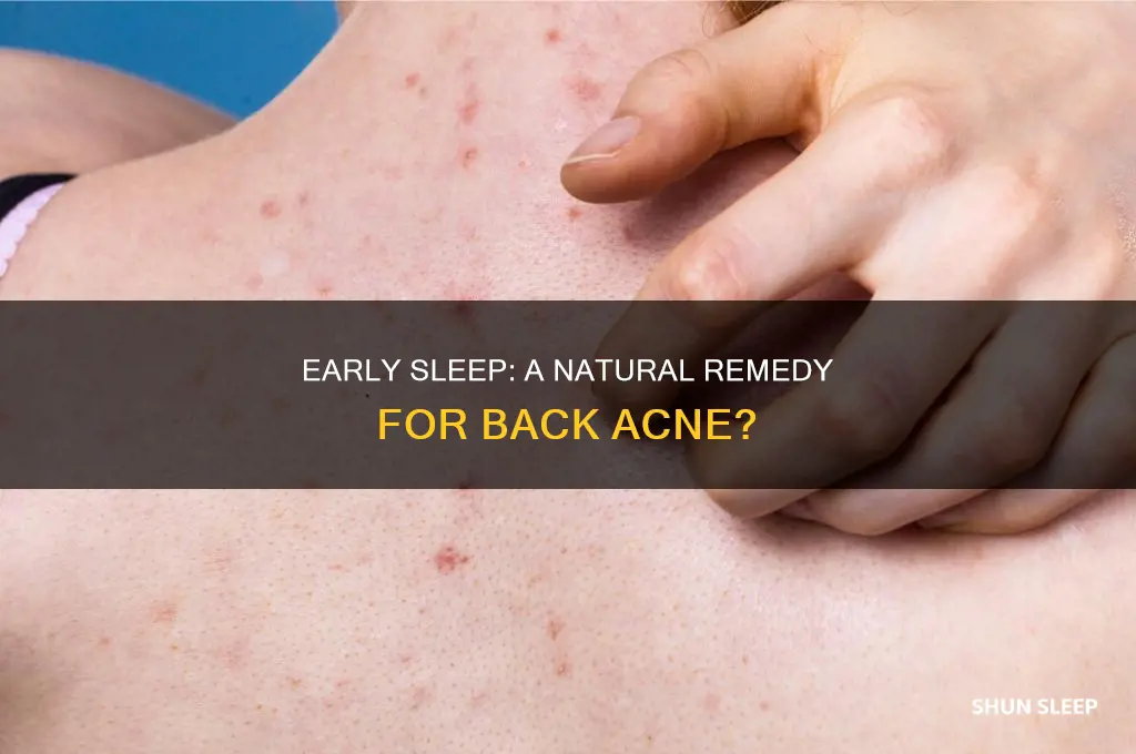 does sleeping early help with back acne