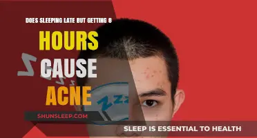 Does Sleeping Late but Getting 8 Hours Cause Acne?