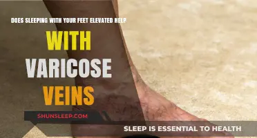 Elevated Sleep: Can It Ease Varicose Veins Discomfort?