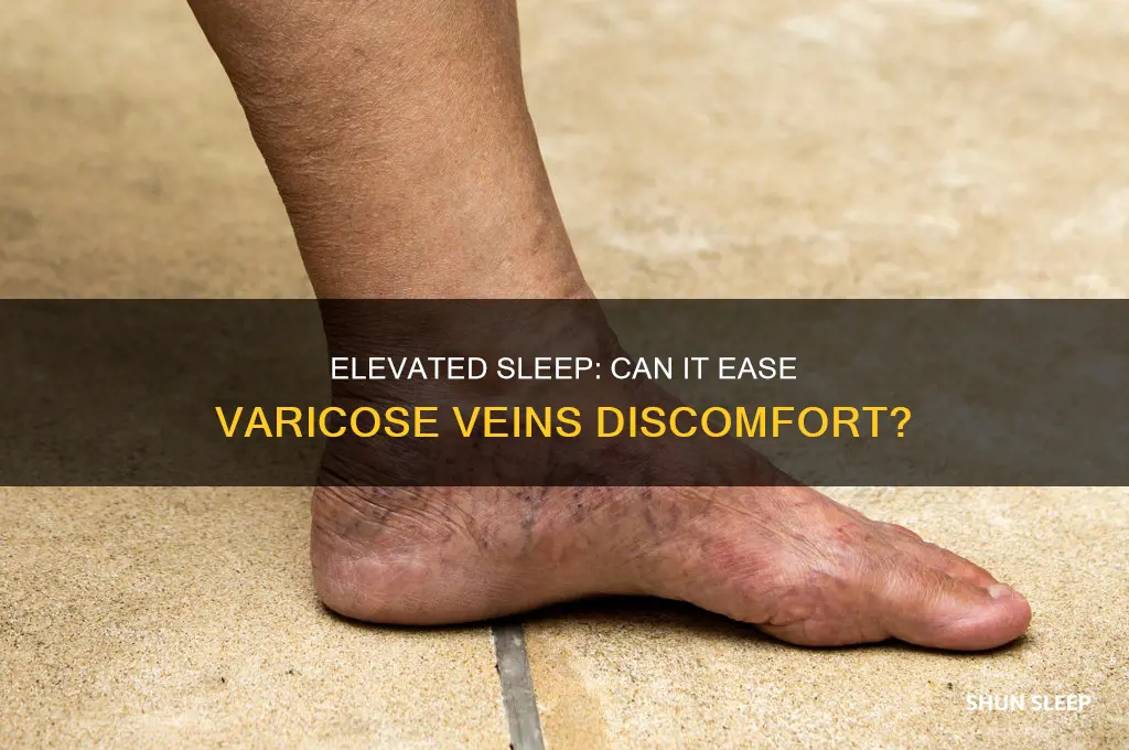 does sleeping with your feet elevated help with varicose veins