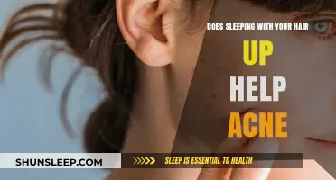 Sleeping with Hair Up: Acne Prevention or Myth?