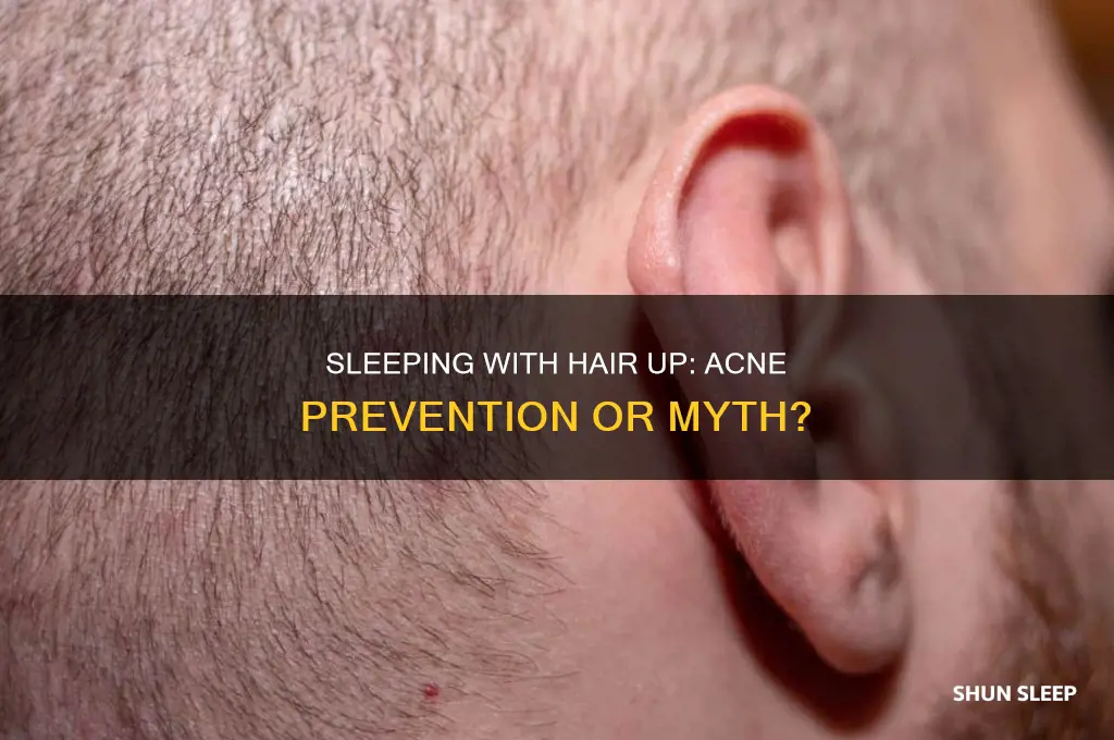 does sleeping with your hair up help acne