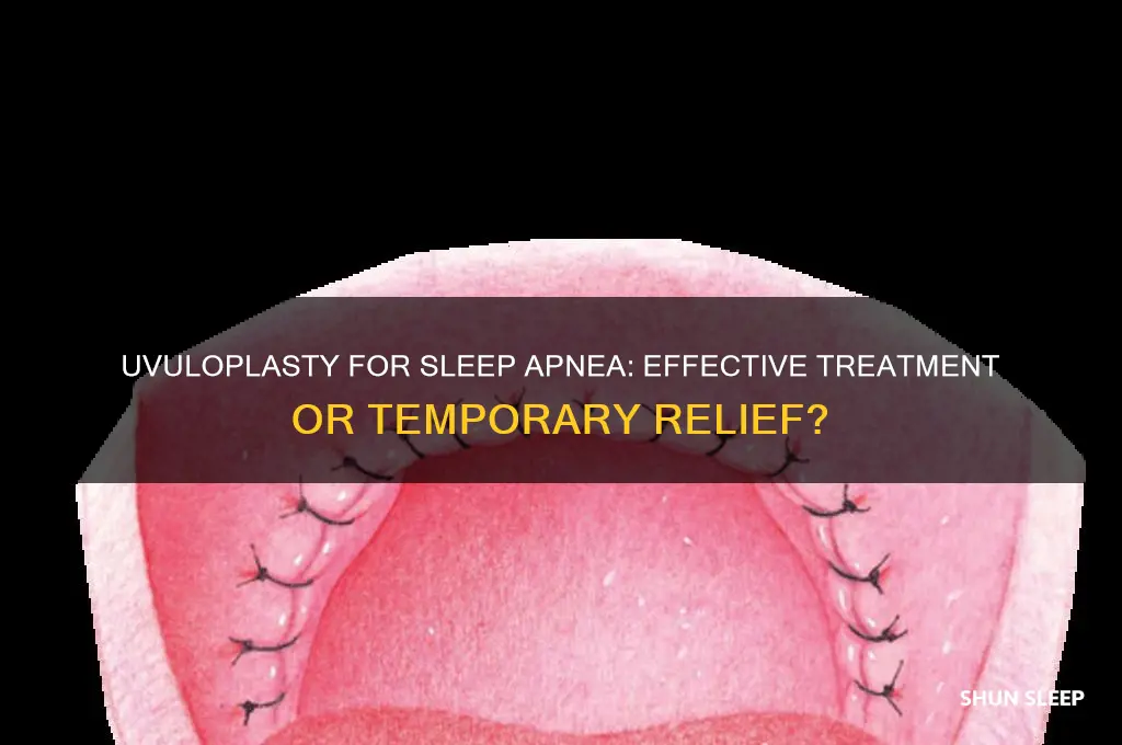 does uvuloplasty help sleep apnea