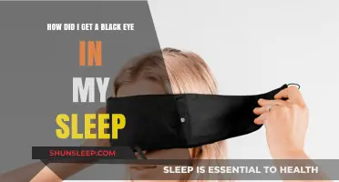 Waking Up with a Mystery: How I Got a Black Eye Overnight