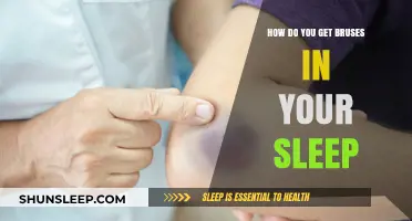 Waking Up Bruised: Understanding Sleep-Related Bruises and Causes