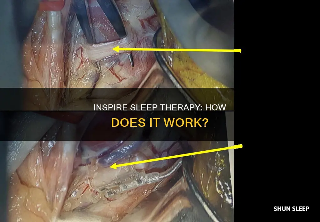 how does inspire work for sleep