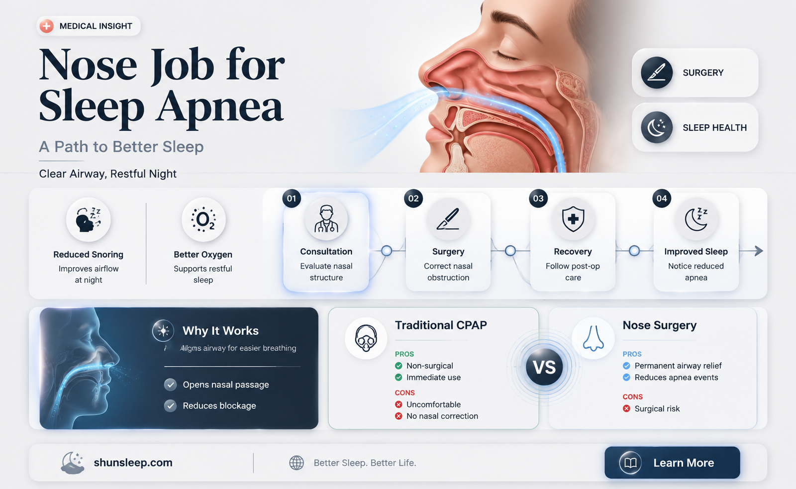 can a nose job help sleep apnea