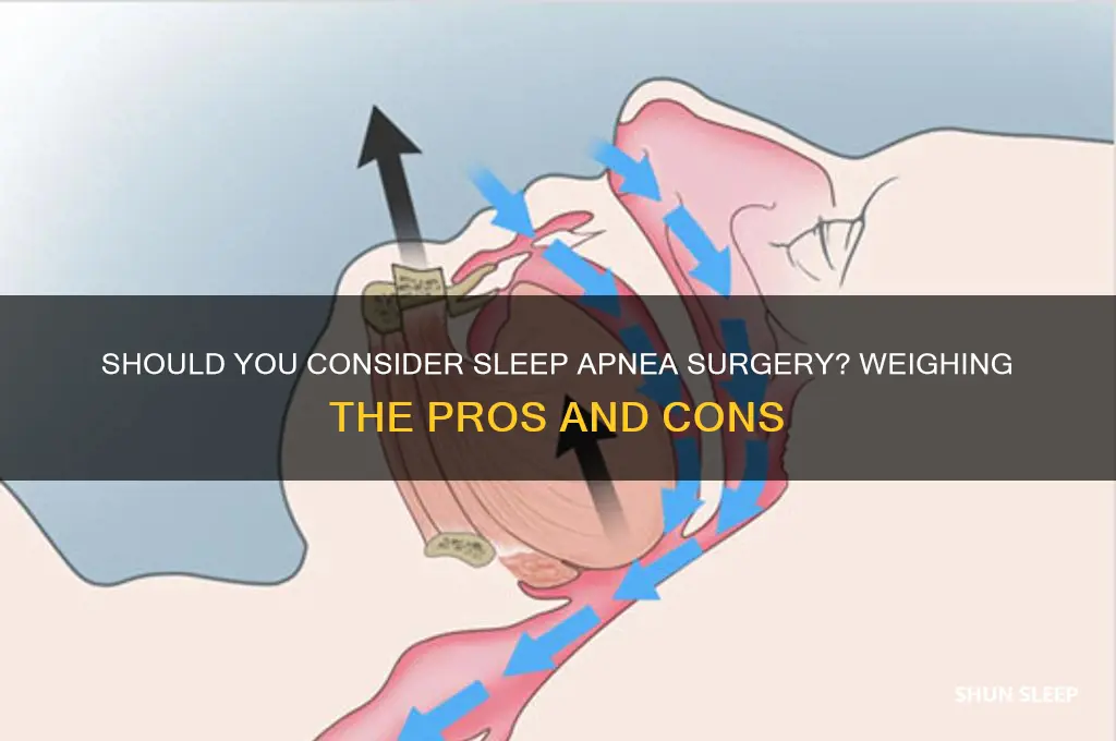 should i get sleep apnea surgery