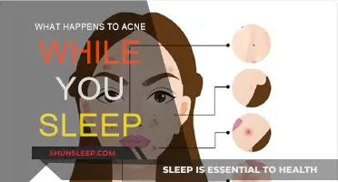 How Sleep Affects Your Acne: A Guide