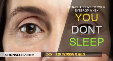 The Dark Side of Sleep Deprivation: Eye Bags