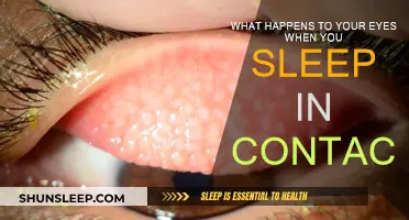 The Risks of Sleeping in Contact Lenses