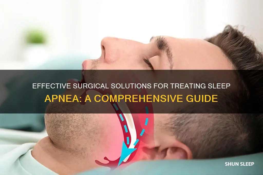 what surgery can help sleep apnea
