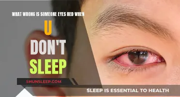 Sleep Deprivation: Why Do Your Eyes Turn Red?