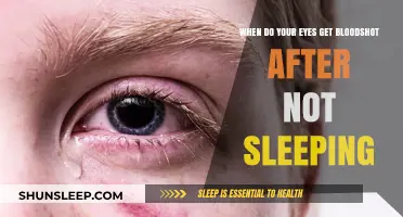 Lack of Sleep and Bloodshot Eyes: Understanding the Connection