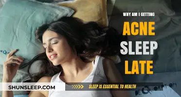 Late Nights, Bad Skin: How Sleep Deprivation Triggers Acne