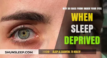 Sleep Deprivation: Eye Bags and Dark Circles