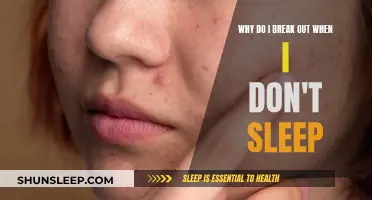 Sleep Deprivation: The Real Culprit Behind Skin Breakouts