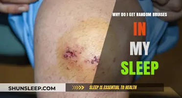 Why Do I Wake Up with Random Bruises? Exploring Sleep-Related Bruising
