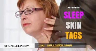Understanding Sleep-Related Skin Tags: Causes, Prevention, and Removal Tips