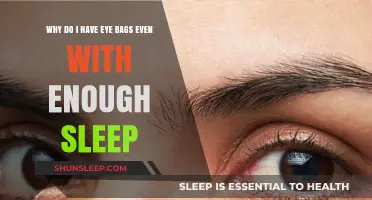 Sleep isn't Everything: Tackling Under-Eye Bags