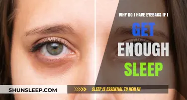 Why Do I Have Eyebags Despite Getting Enough Sleep?